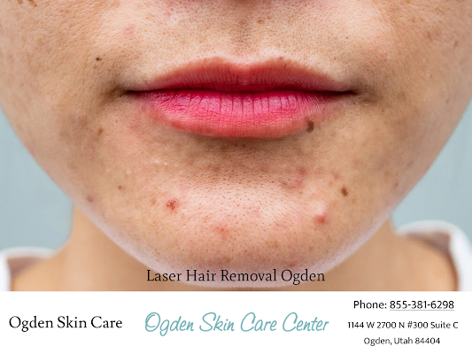 Say Goodbye to Acne Scarring with Professional Acne Treatments in Ogden, Utah