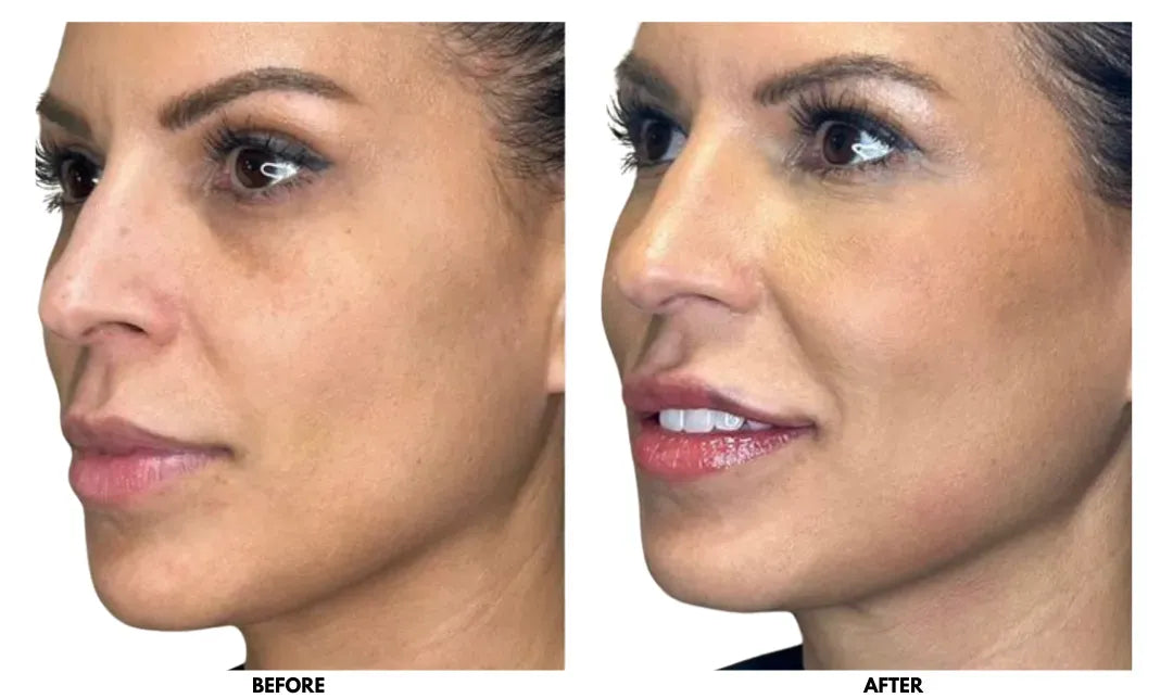 Whatever You Need to Understand About Plasma Filler: Enhance Your Natural Appeal