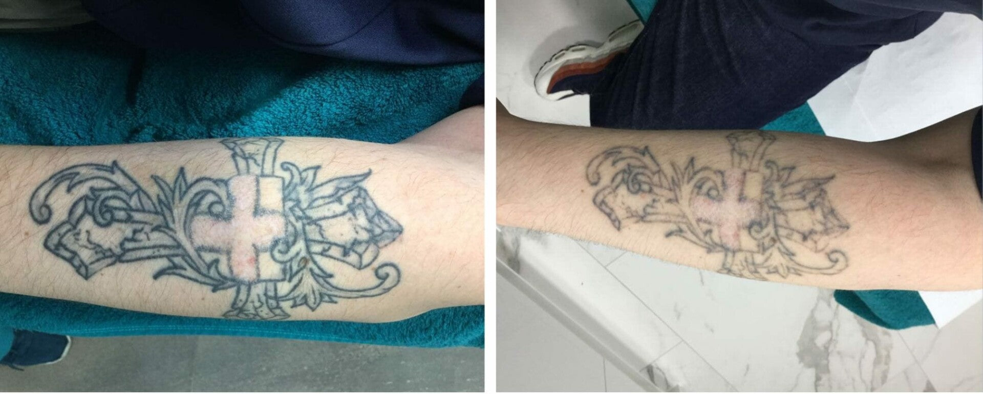 laser tattoo removal