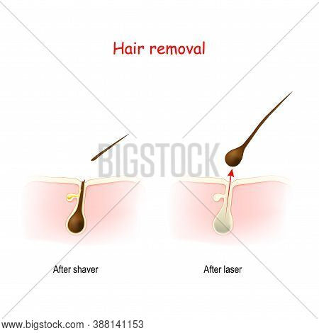 Laser Hair Removal Near Me