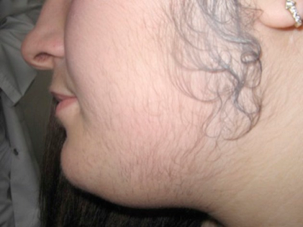 Hirsutism