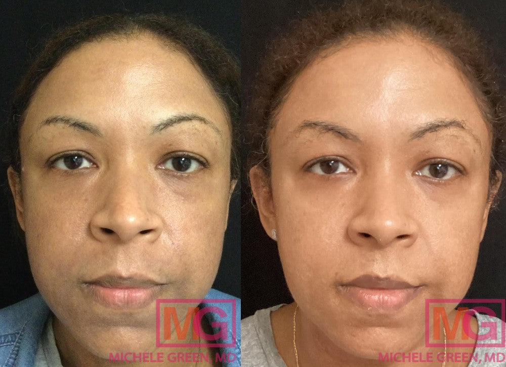 microneedling raleigh nc