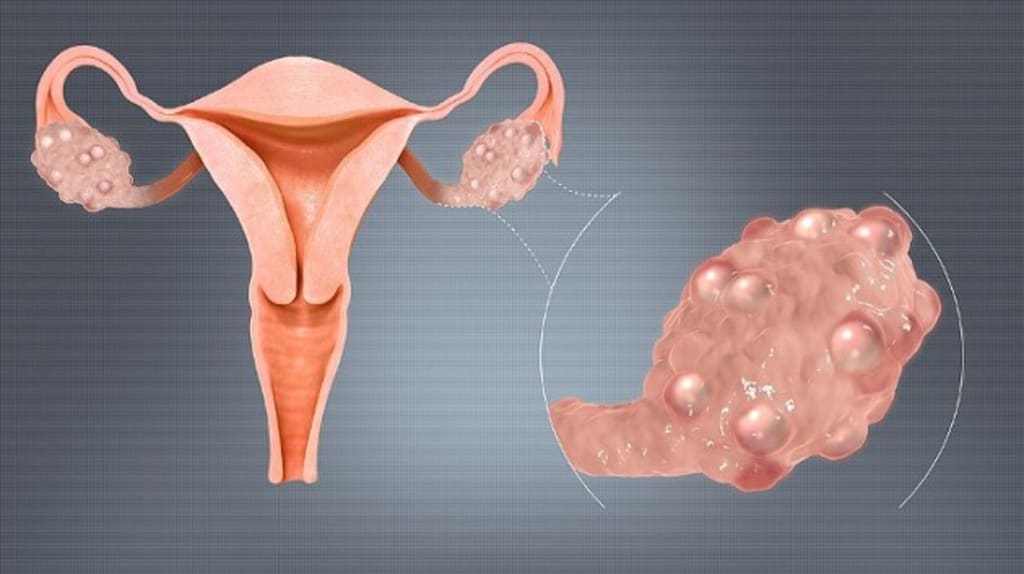 What Women Should Know About Polycystic Ovary Syndrome (PCOS)