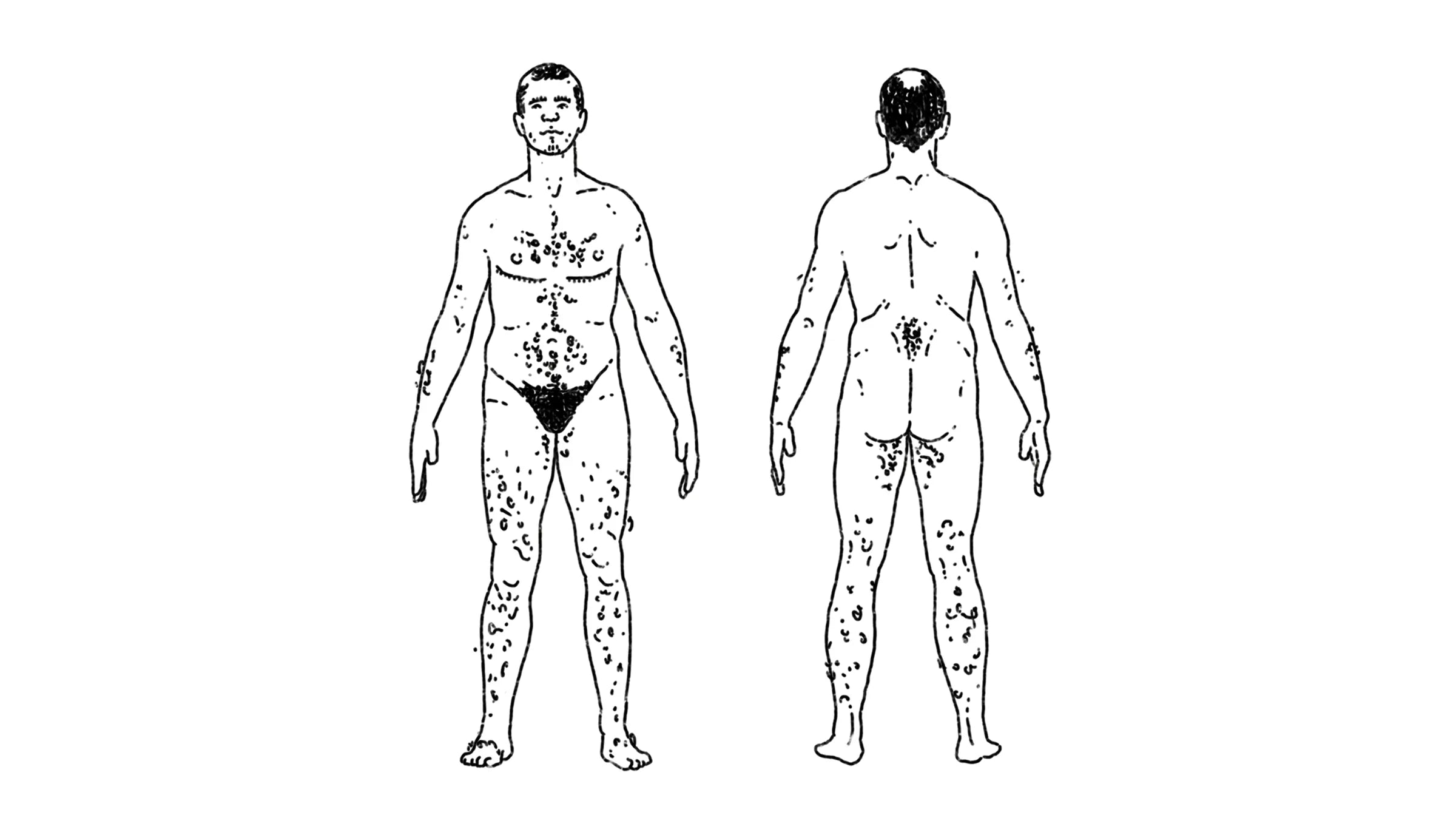 An illustration of how testosterone hormone therapy effects hair growth