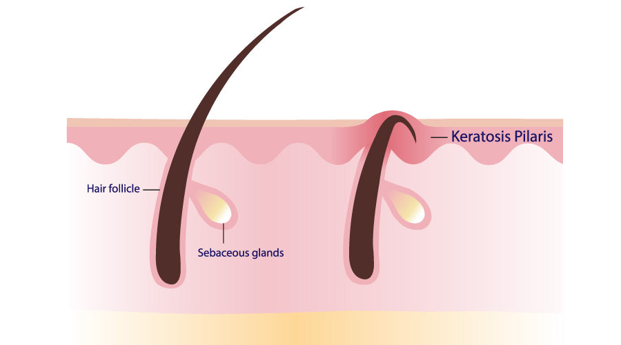 Keratosis Pilaris: Its Causes, Symptoms, and Treatment