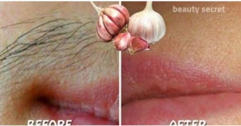 Say Goodbye to Unwanted Hair with Garlic