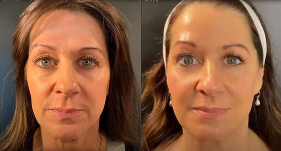 Microneedling: Exactly How This Revolutionary Treatment Can Transform Your Skin