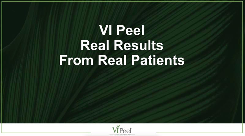 Clearstone offers VI Peel® – the next generation in medical grade chemical peels, formulated by Vitality Institute Medical Products.