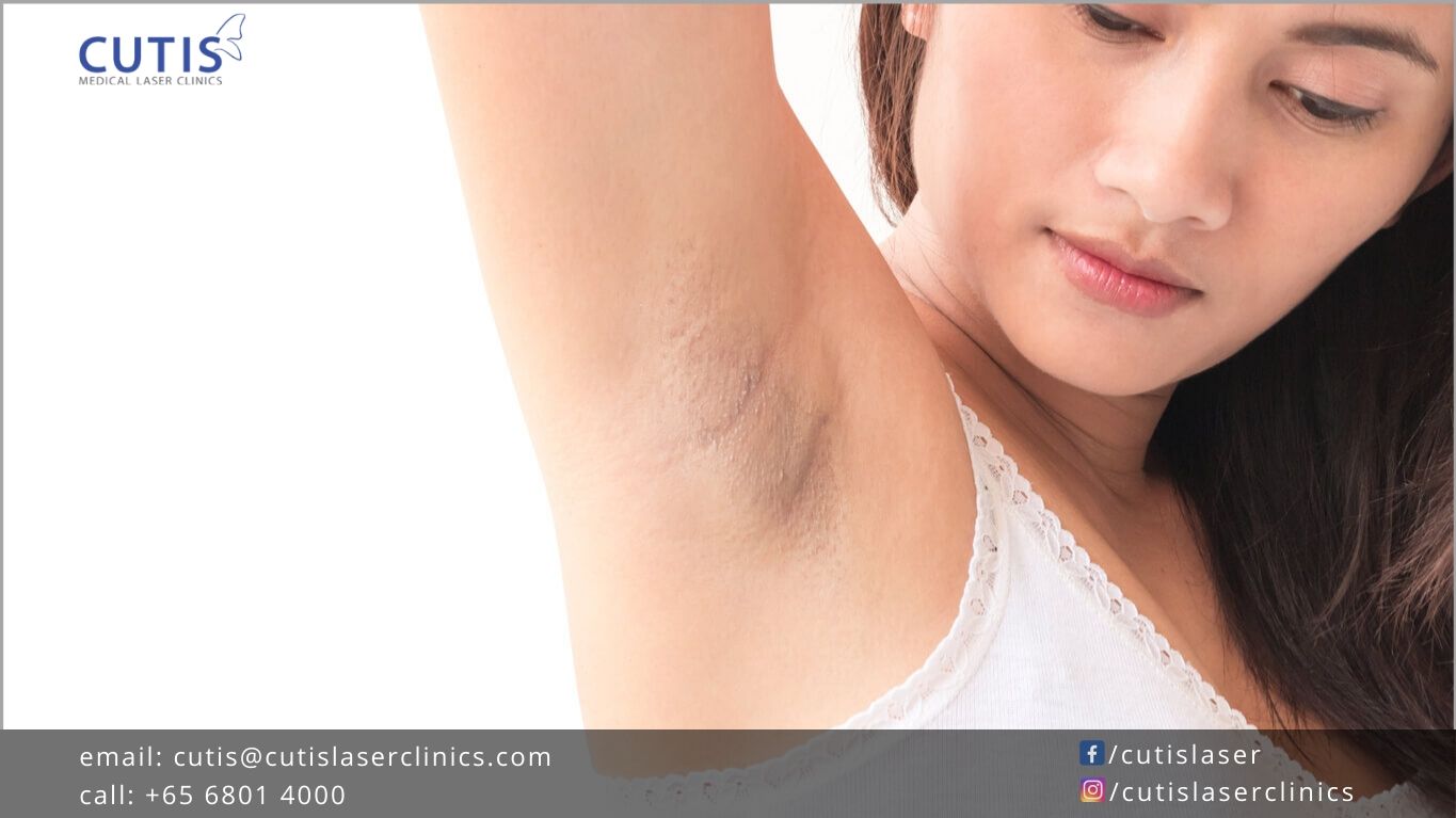 Do You Have Dark Underarms?