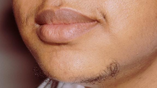 Facial Hair On Women: How To Treat It With Different Types Of Tea