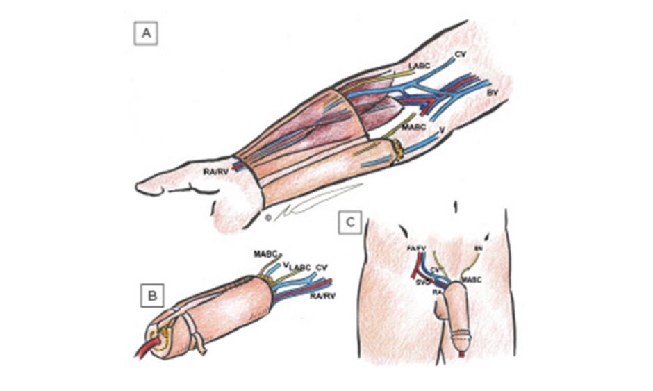 Editor’s Pick: Penile Reconstruction: Current Thoughts, Techniques, and Outcomes