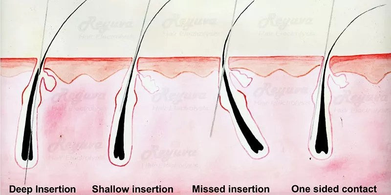 You are currently viewing How Does Thermolysis Destroy Hair Follicles?