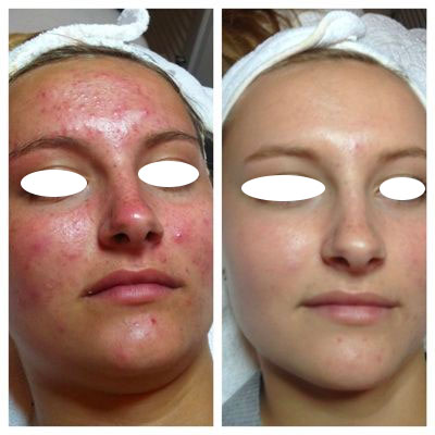 Skinbody Nashville Hydrafacial