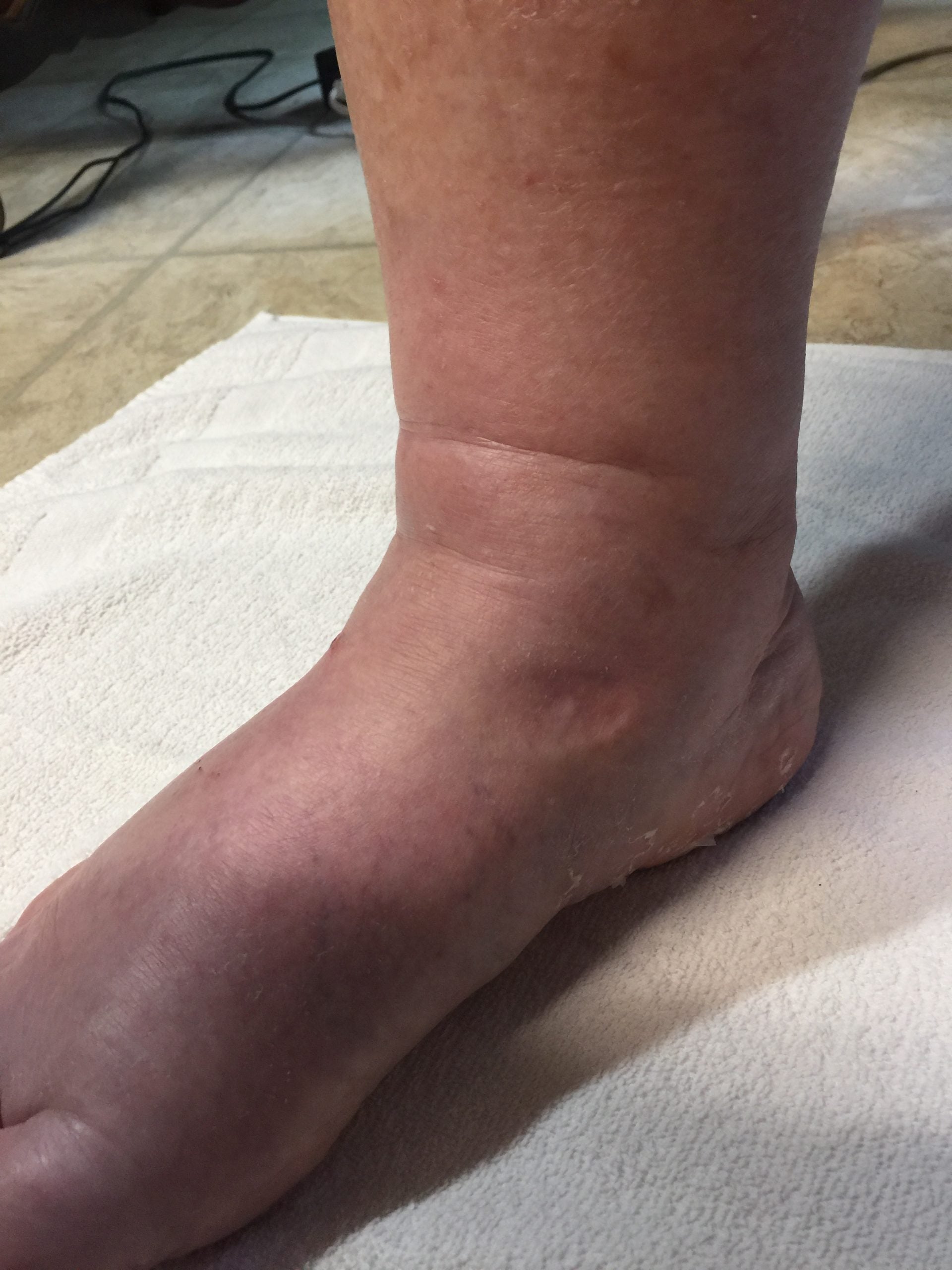 Figure 11: Pitting edema.