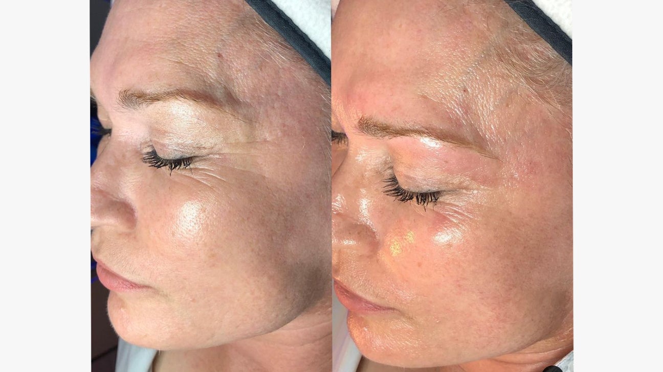 Skinbody Nashville Chemical Peel