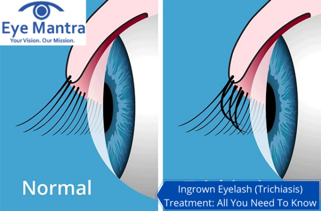 Ingrown Eyelashes (Trichiasis)