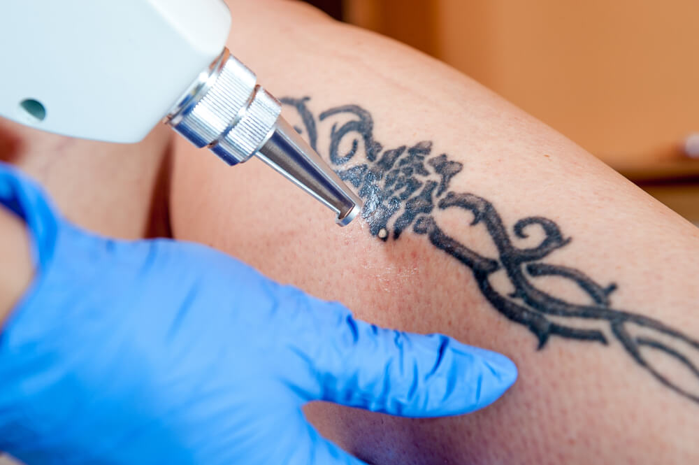 Why Does Location Matter For Tattoo Removal