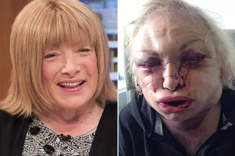 Kellie Maloney: Surgery nearly killed me and turned me into a monster