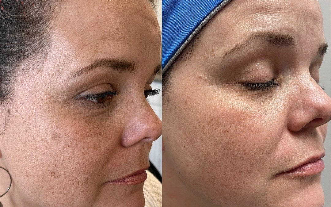 Microneedling Raleigh NC