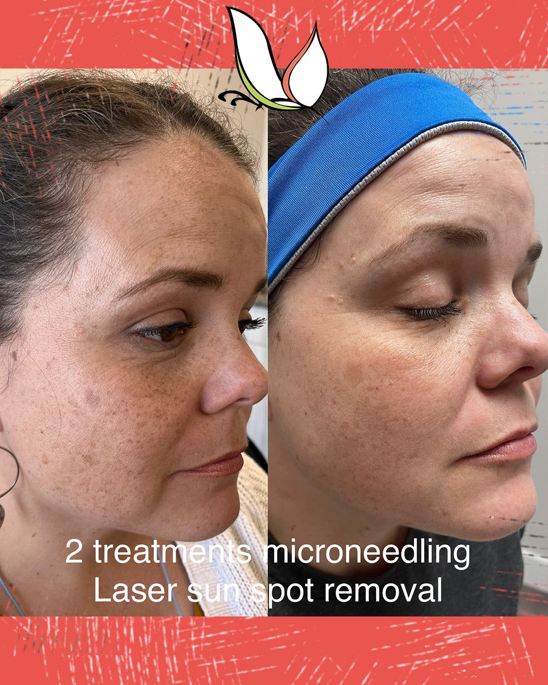 microneedling raleigh nc