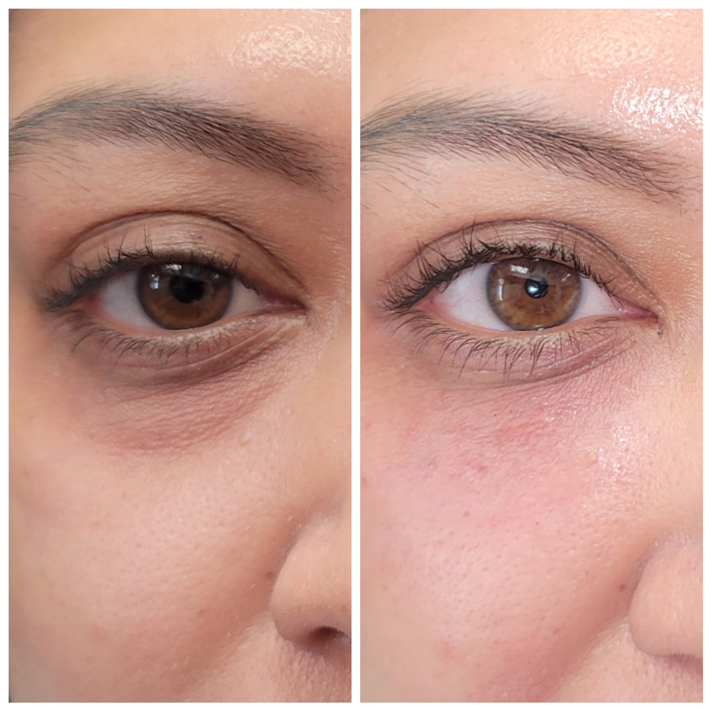 Enhance Your Appearance with Plasma Filler: Safe and Lasting Results