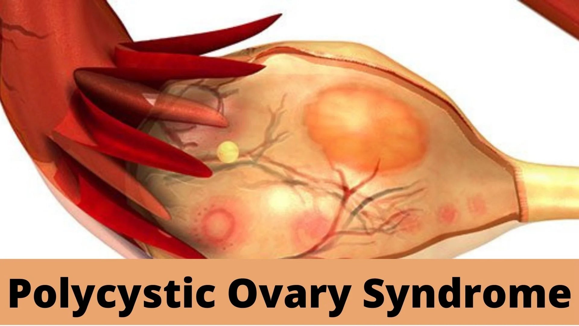 Polycystic Ovary Disease