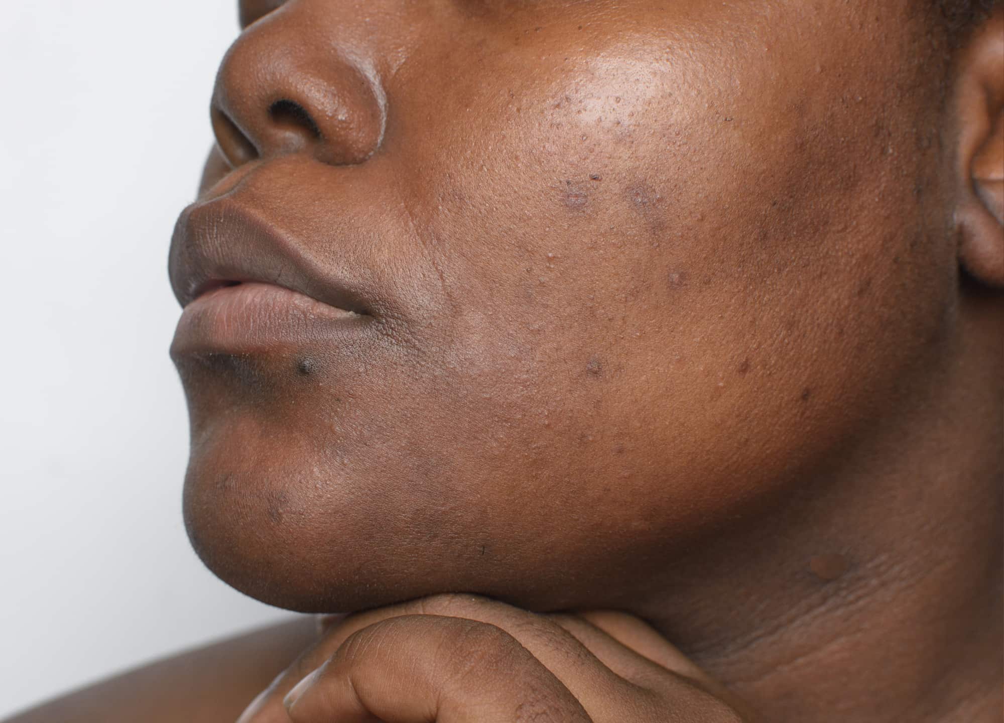 6 Cosmetic Procedures That Are Safe for Skin of Color