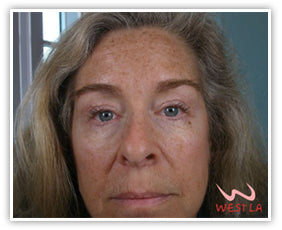 Wrinkle and Facial Scar Resurfacing – DermaSurfacing™