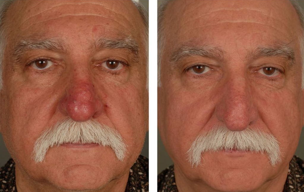 The Power of Plasma Filler: Achieve Youthful, Plump Skin with Ease