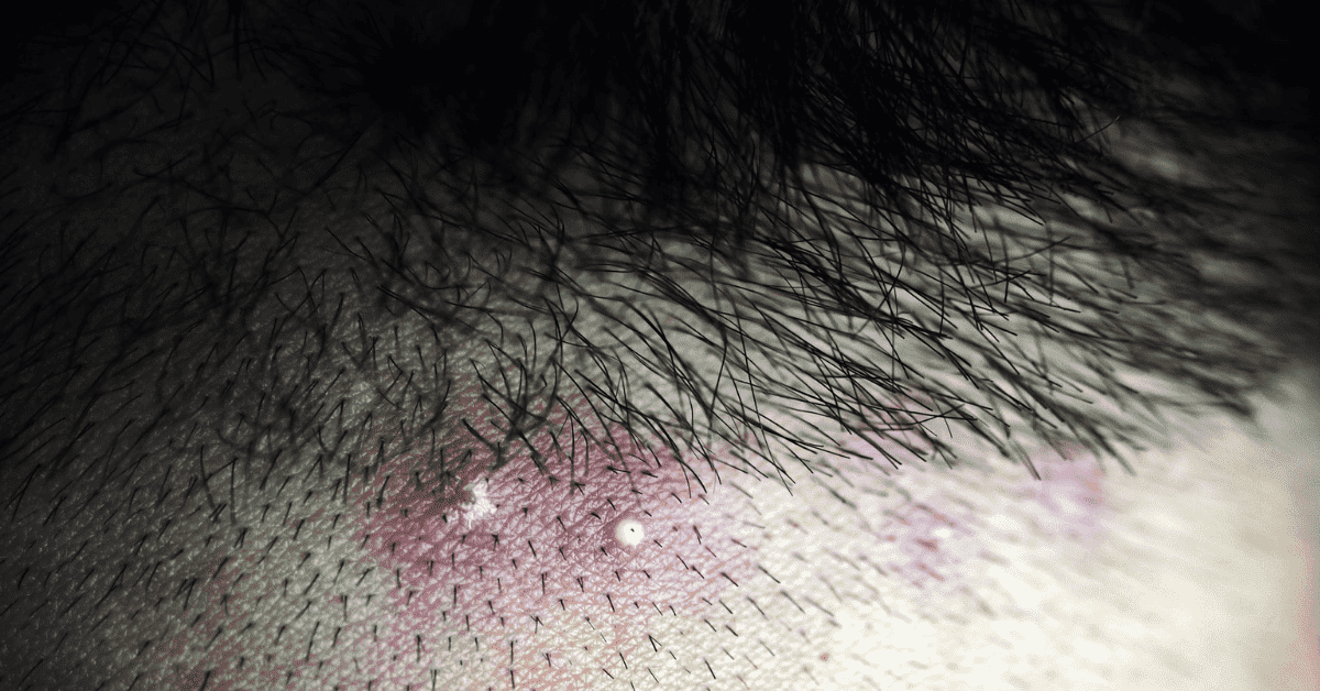 Scalp Folliculitis