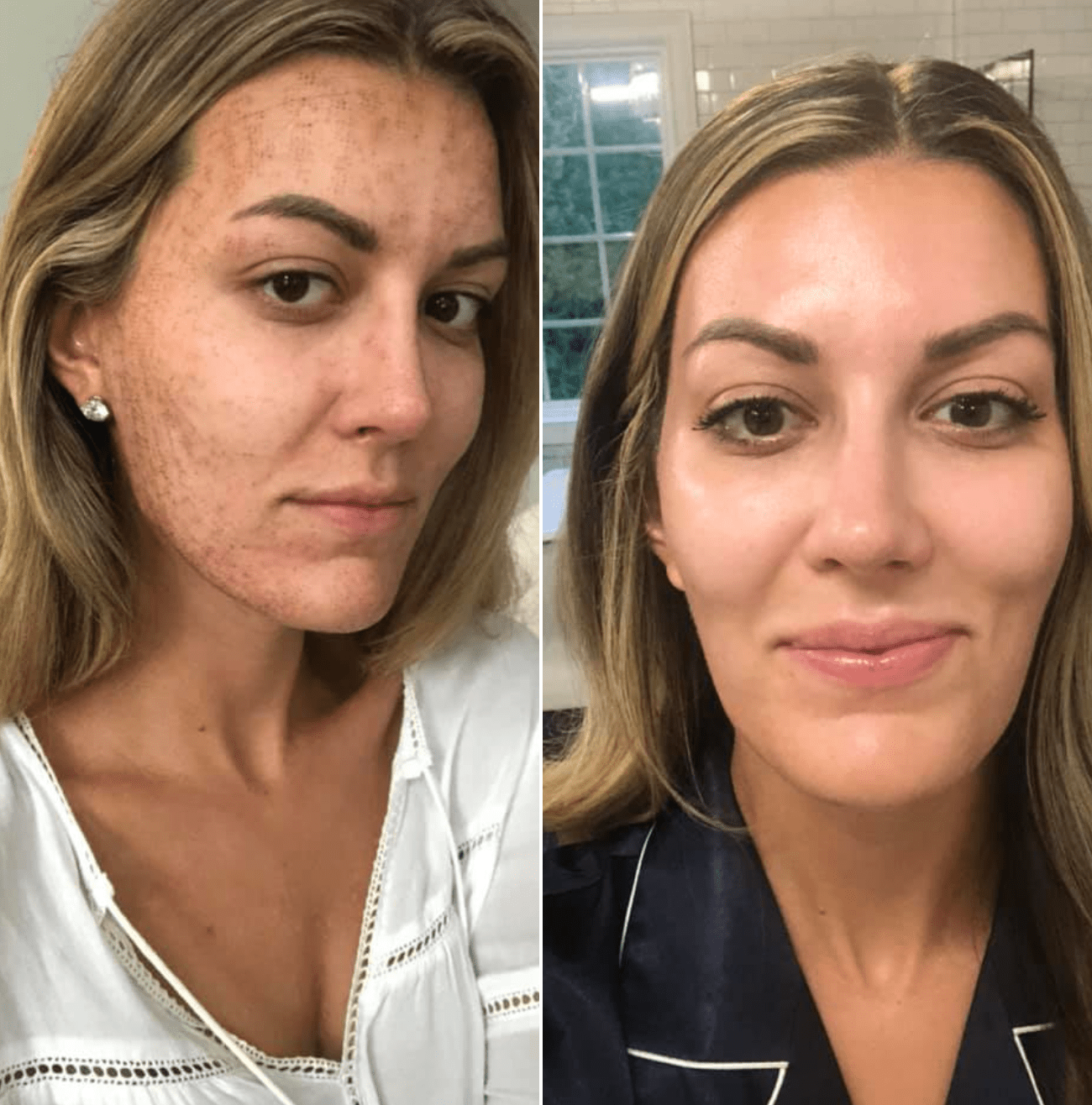 Microneedling Raleigh NC