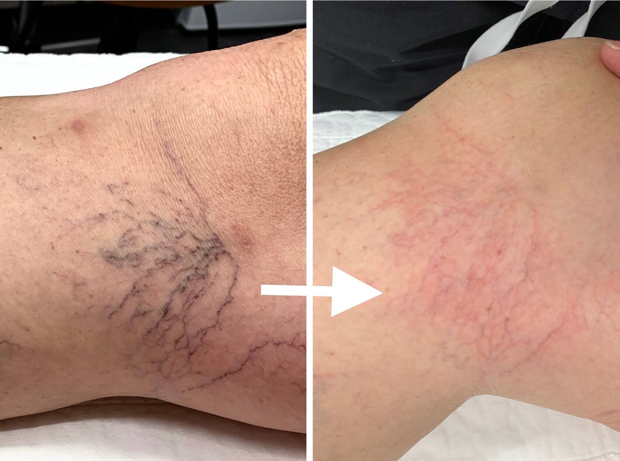 Thread Vein Treatment