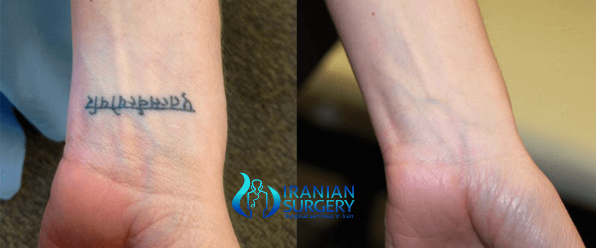 Tattoo removal