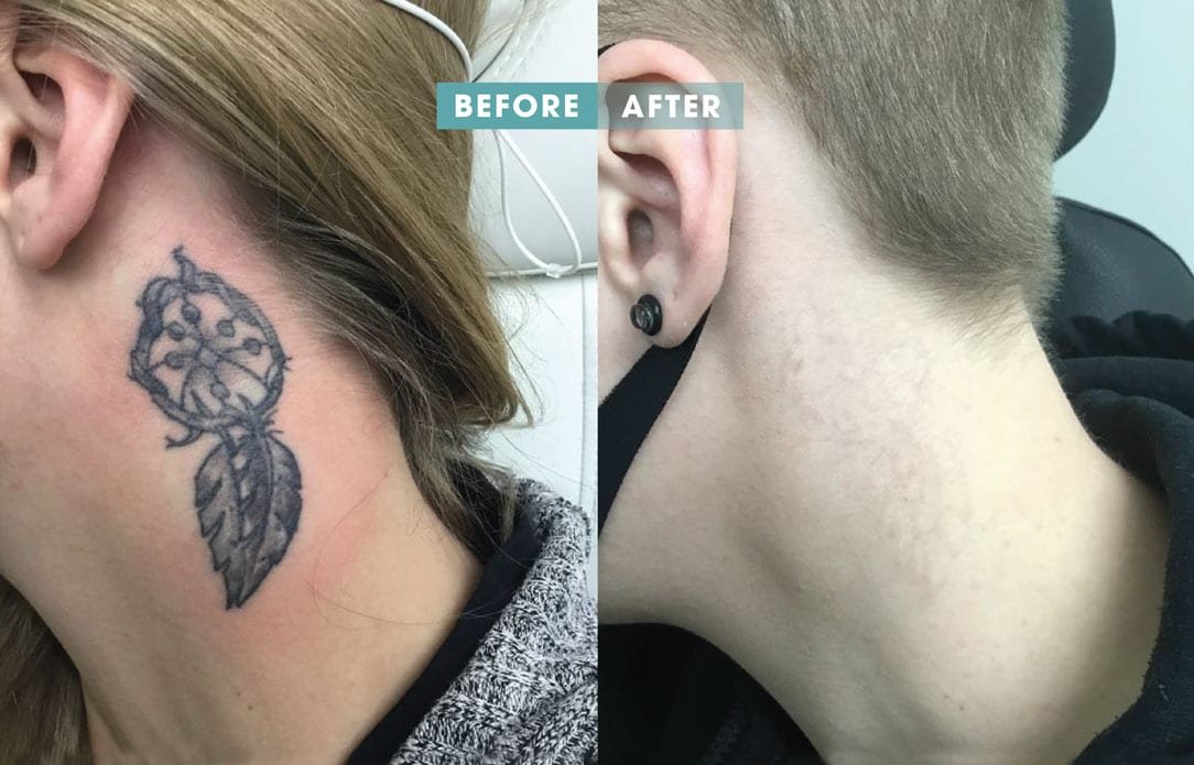 Tattoo Removal Before and After