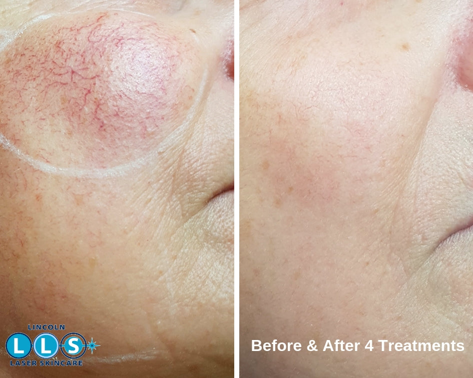 Thread Vein Treatment