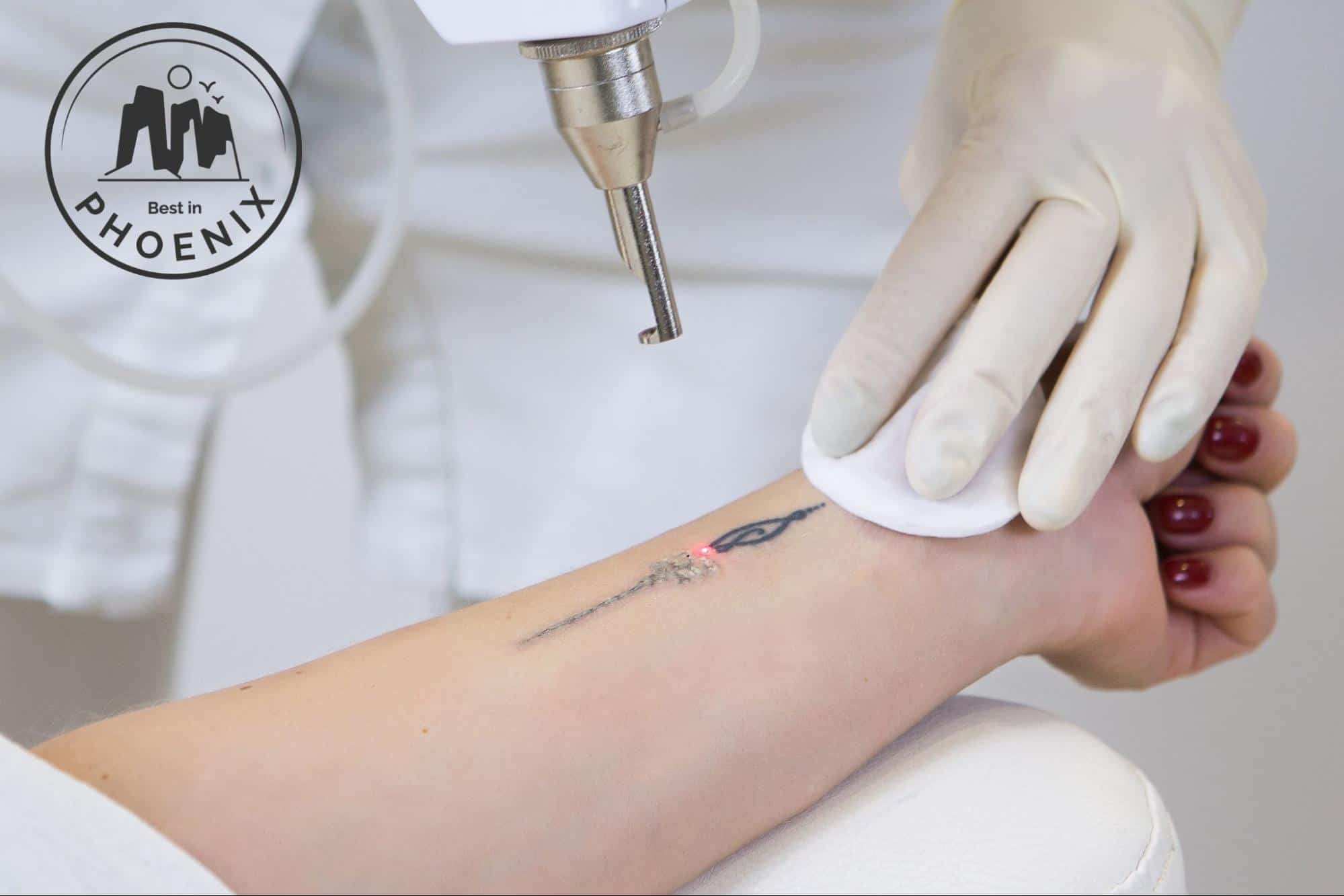 The 5 Best Tattoo Removal Services in Phoenix