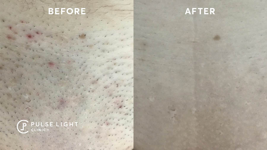 Before and After Laser Ingrown Hair Removal Bikini