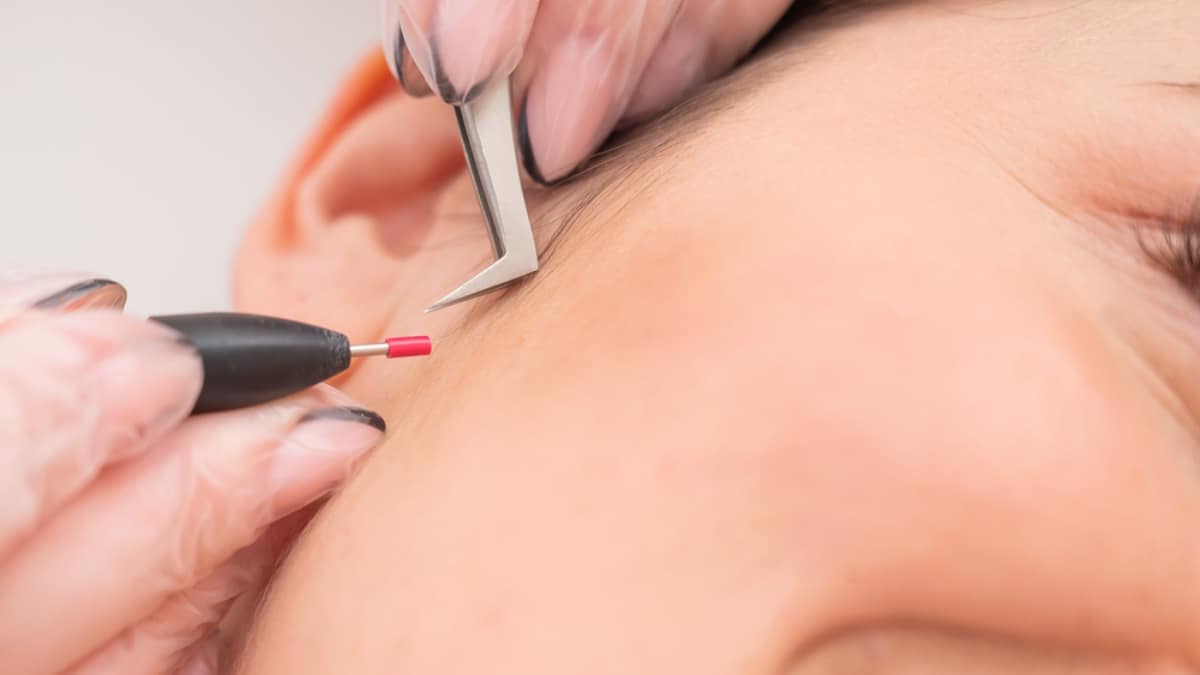 What is Electrolysis Hair Removal?