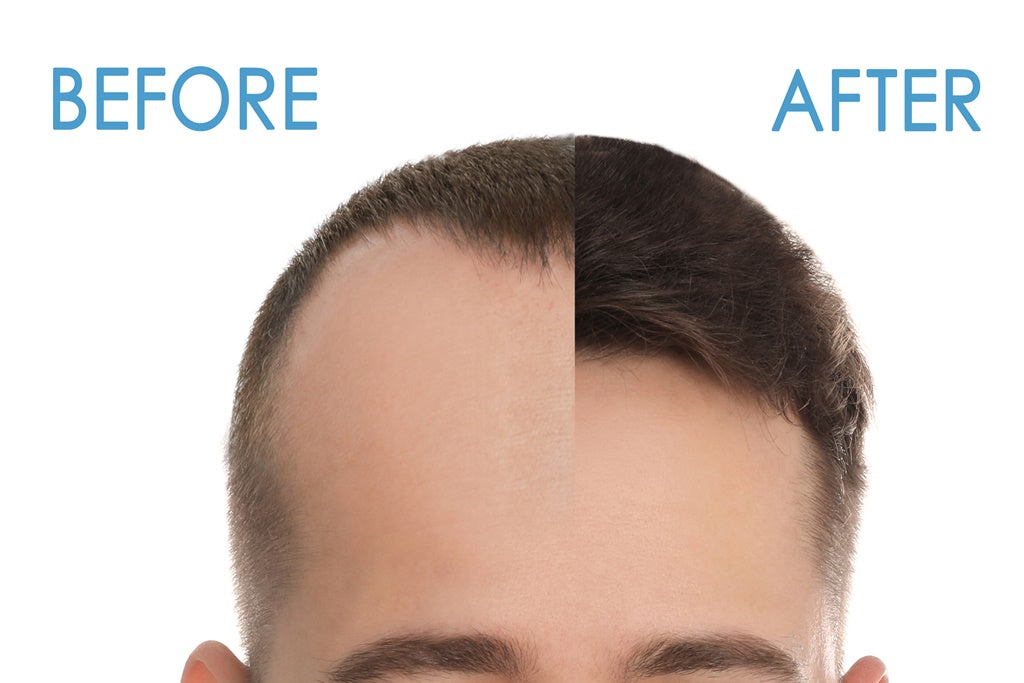 Repair Hair Transplant in Turkey