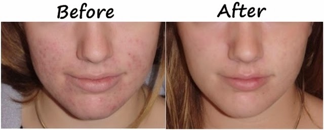 acne vulgaris