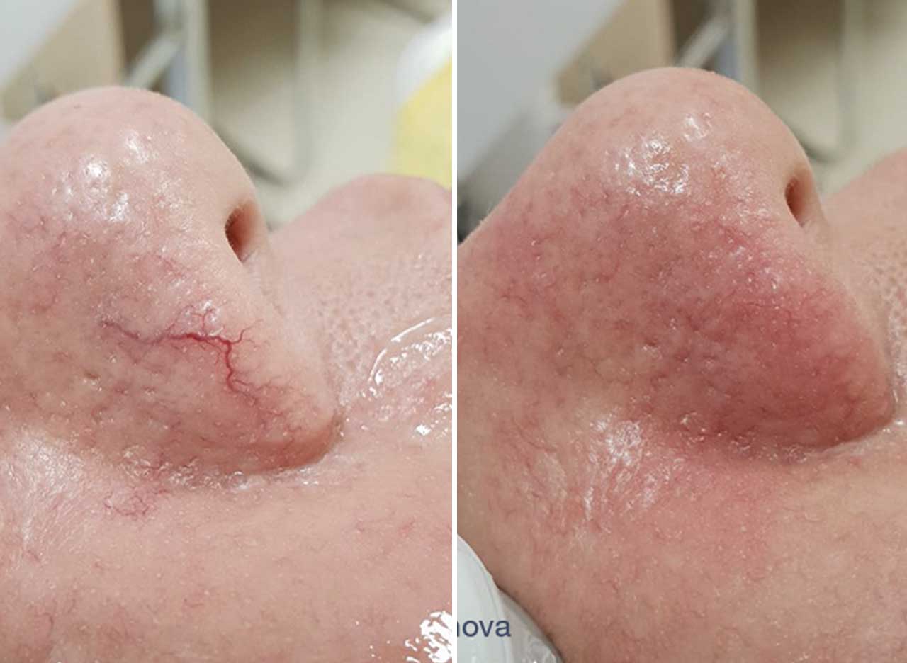 Thread Vein Treatment