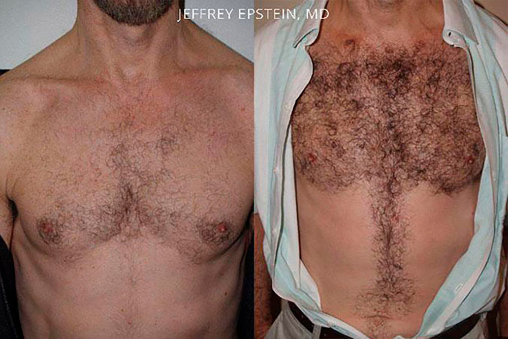 Body Hair Transplants in Miami