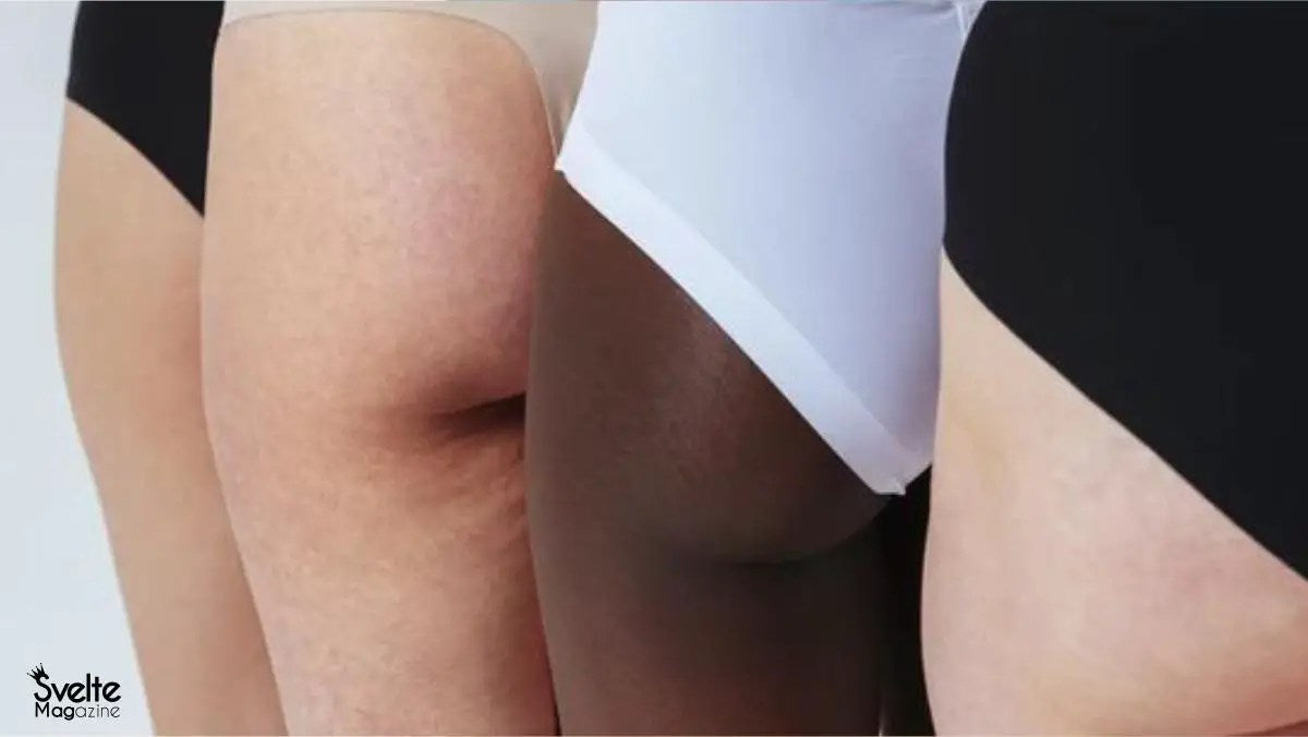 Butt Acne: How to Get Rid of Pimples on Your Buttocks