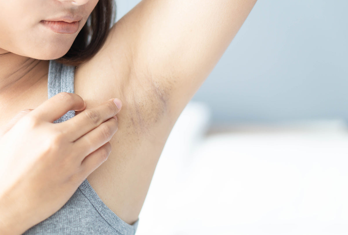 How to Lighten Underarms: Causes & Treatments