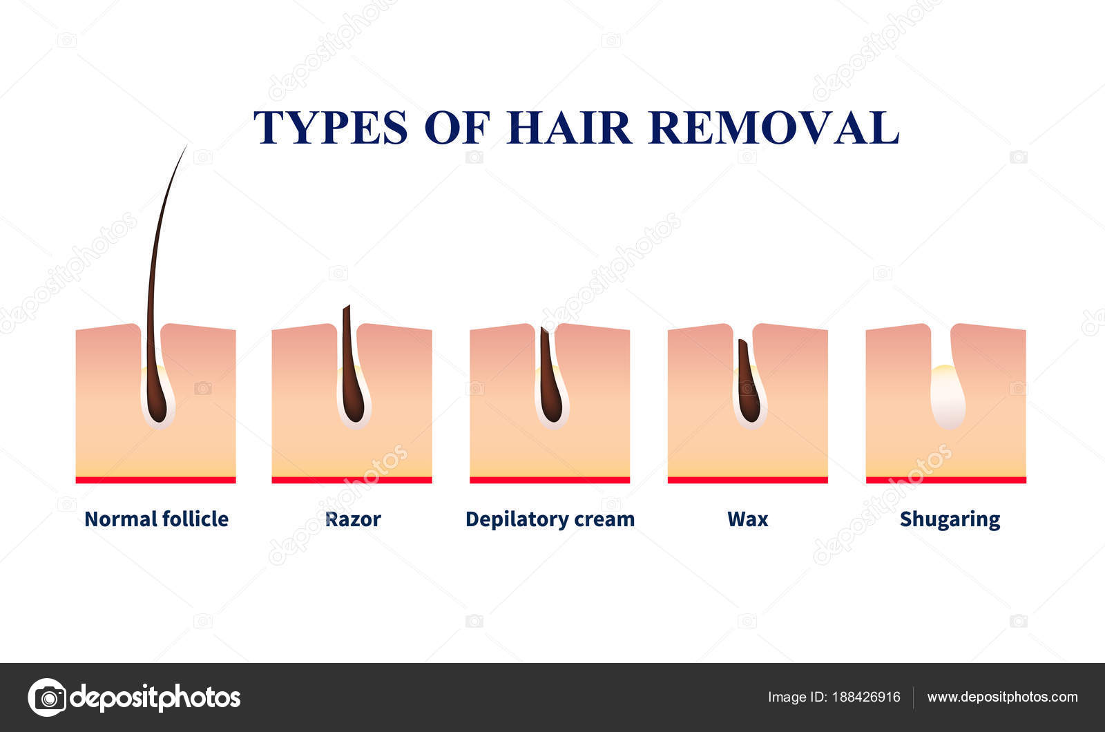 Hair Removal