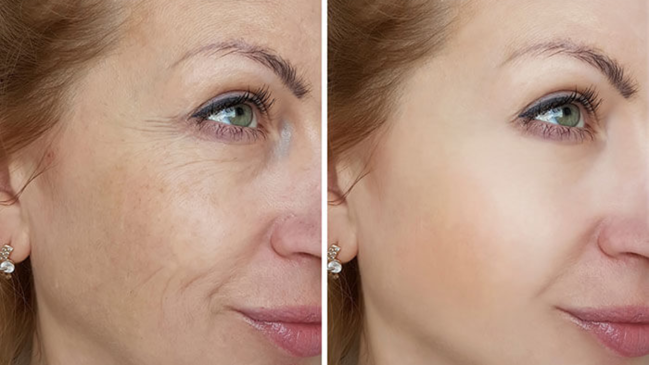 Microneedling Raleigh NC