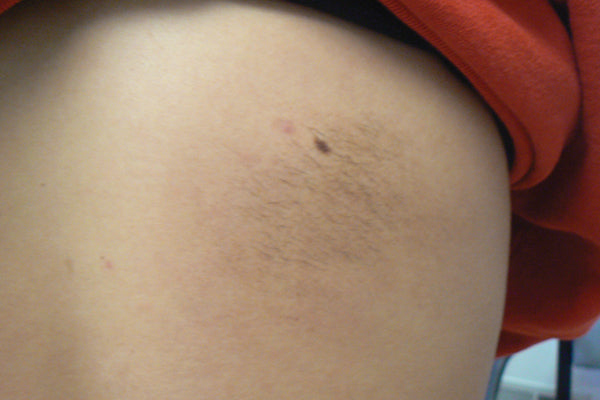 Hyperpigmented patch with hypertrichosis