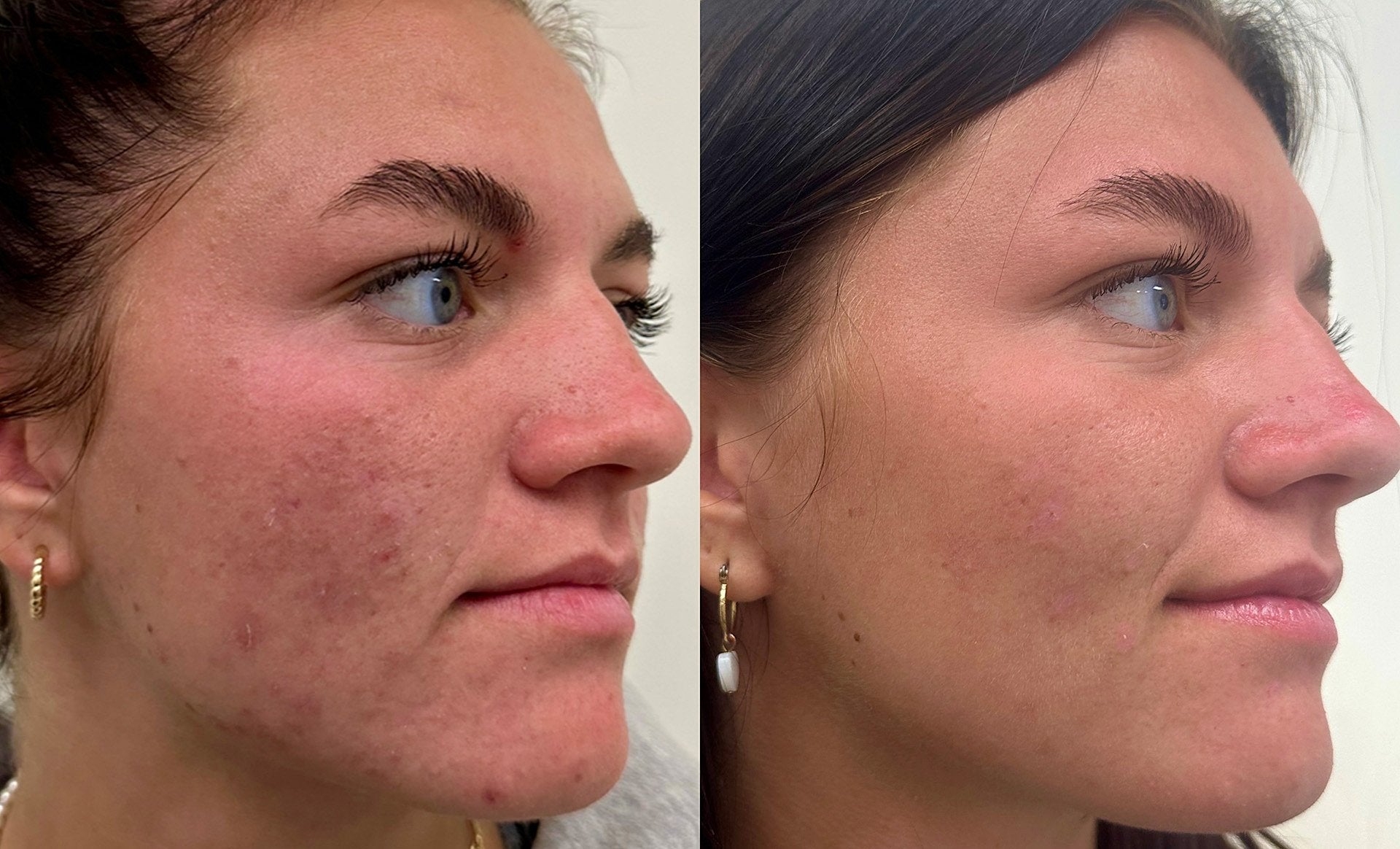 Microneedling: How This Revolutionary Treatment Can Transform Your Skin