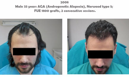 Civas Hair Transplant