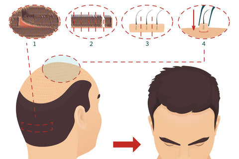 Hair Transplant Scars Removal: How Effective Is It?